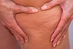 Cellulite Behandlung